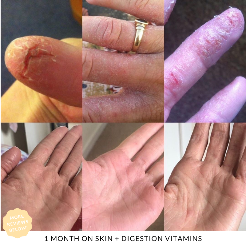 1 month results using JS HEALTH  Skin + Digestion